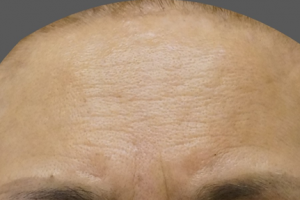 이마 및 미간 주름 필러 시술